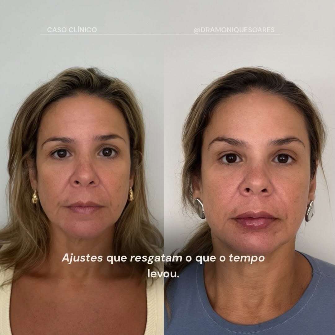 Caso clínico · harmonização facial · ajustes que resgatam o que o tempo levou (antes e depois)