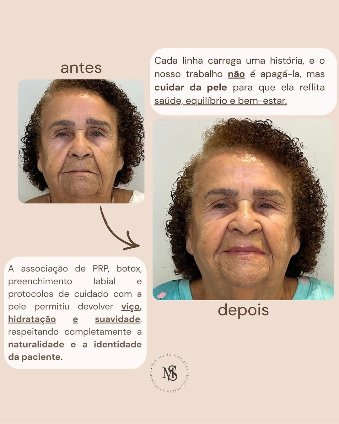 Caso clínico · paciente sênior · antes e depois com PRP, botox e preenchimento labial