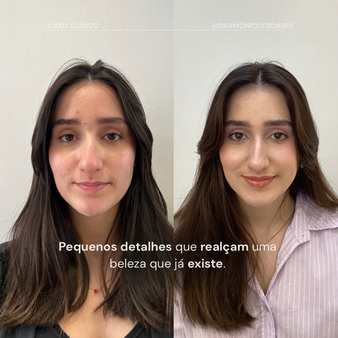 Caso clínico · pequenos detalhes que realçam a beleza que já existe (antes e depois)