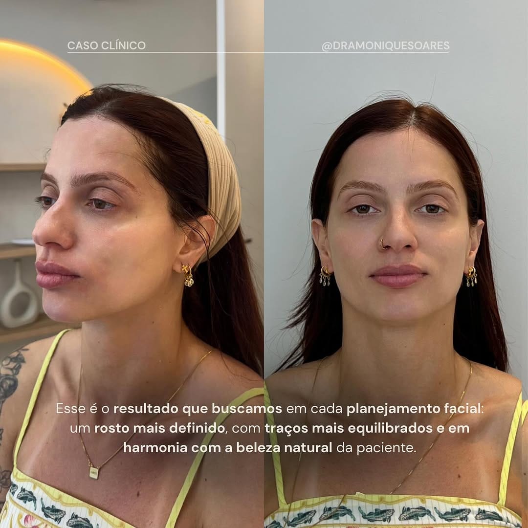 Caso clínico · planejamento facial com protocolo MS Beauty (antes e depois)