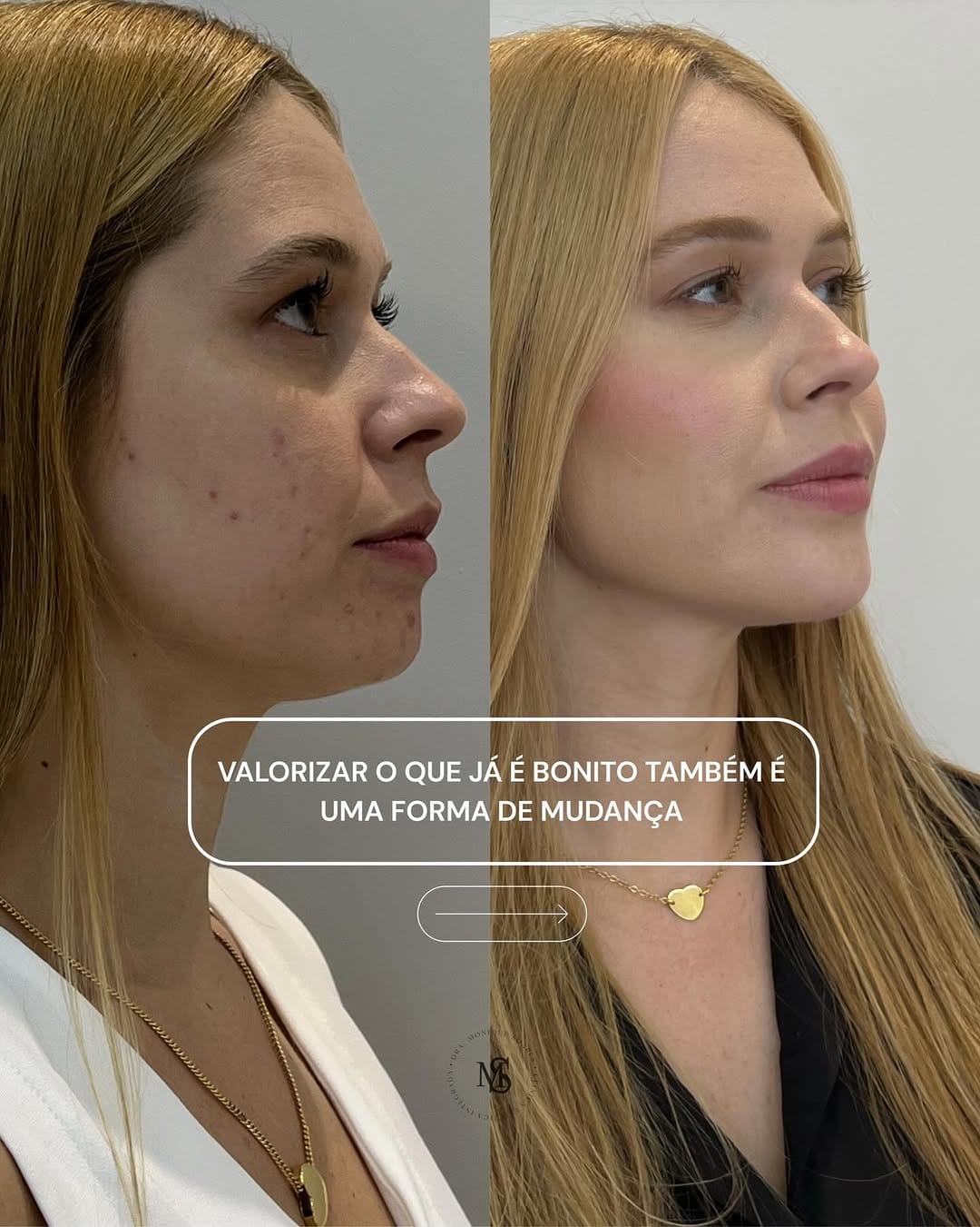 Caso clínico · projeção e definição do contorno facial (antes e depois em perfil)