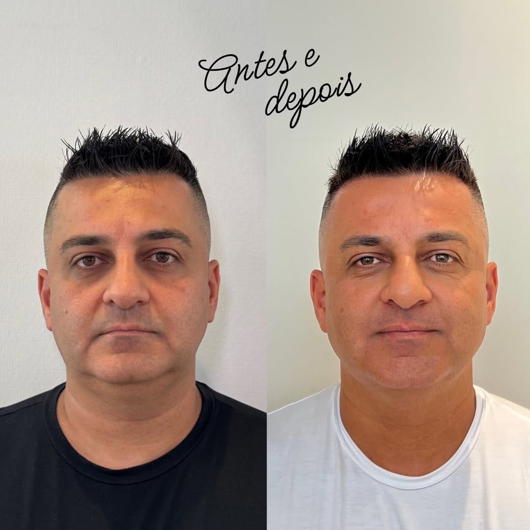Caso clínico · harmonização facial masculina (antes e depois)