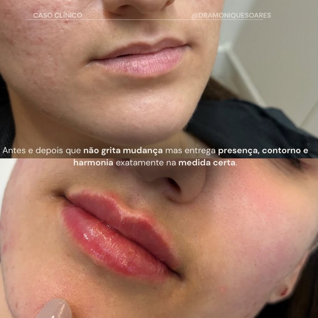 Caso clínico · preenchimento labial · antes e depois com foco em contorno e hidratação