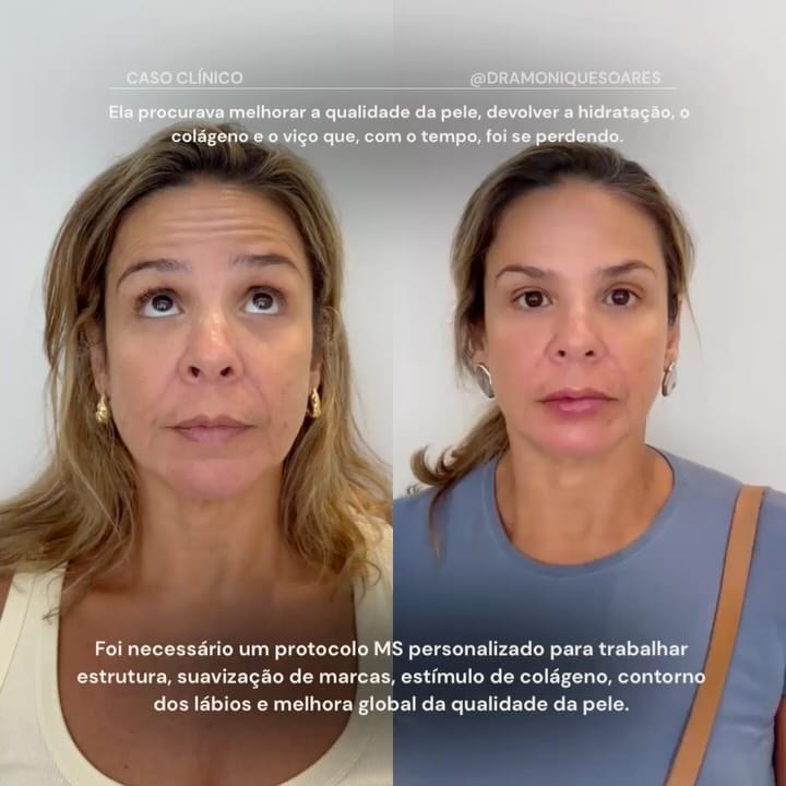 Caso clínico · protocolo MS Beauty personalizado · antes e depois frontal